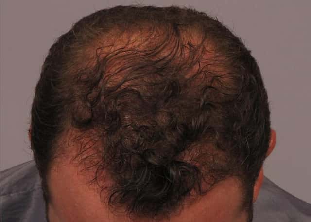 FUE Results Achieved with SmartGraft or Neograft Before & After Case 298 after