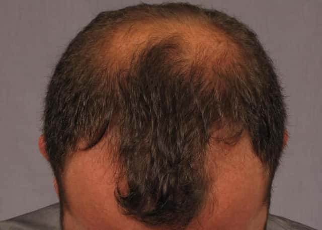 FUE Results Achieved with SmartGraft or Neograft Before & After Case 298 before