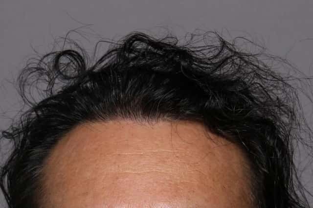 SmartGraft Hair Restoration Frontal View Pre and 1 Year After 3,500 Grafts