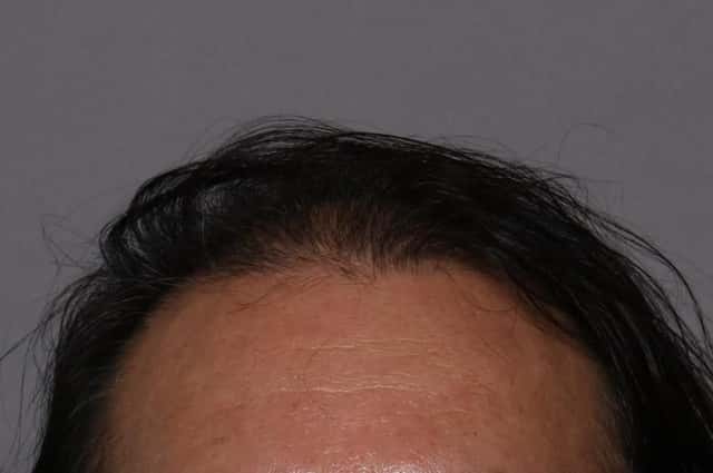 SmartGraft, Frontal View, Naples Florida, Kent V. Hasen Aesthetic Plastic Surgery & Med Spa of Naples
