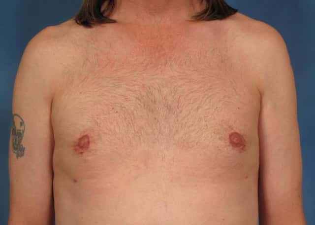 Gynecomastia Before & After Case 178 after