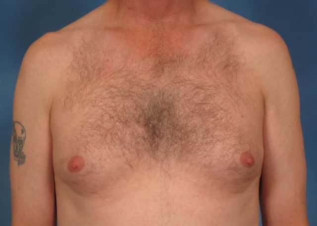 Gynecomastia Before & After Case 178 before