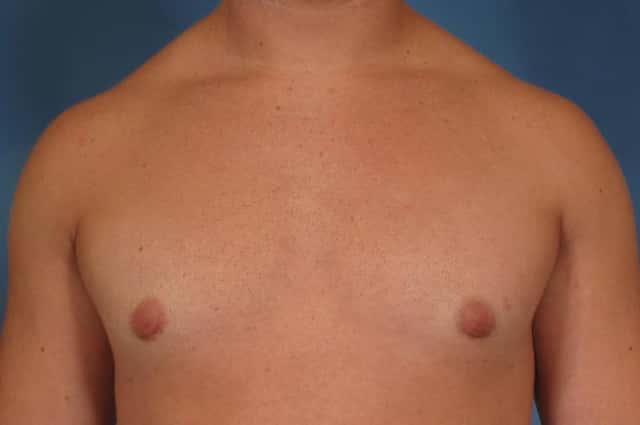Gynecomastia Before & After Case 191 after
