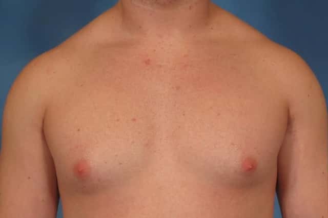 Gynecomastia Before & After Case 191 before