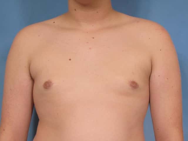 Gynecomastia Before & After Case 86 after