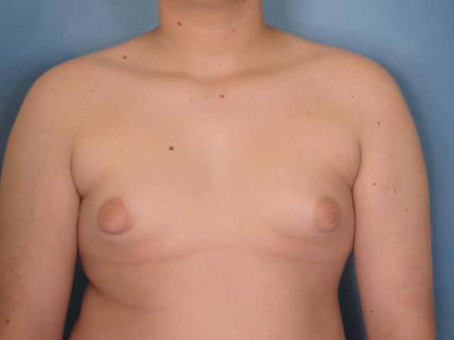 Gynecomastia Before & After Case 86 before
