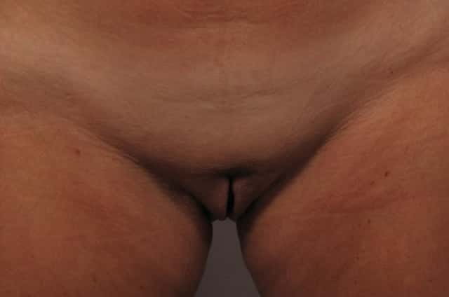 Labiaplasty patient Standing 3 Months Post-op