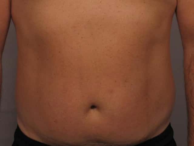 Post 1st Laser Hair Removal Treatment of Stomach