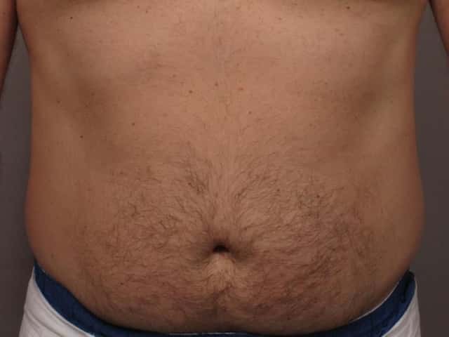 Pre Laser Hair Removal Treatment of Stomach