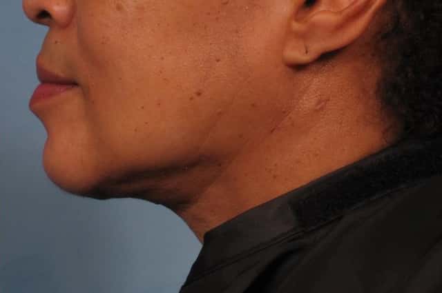 Renuvion Lower Face and Neck Lift Before & After Case 265 after