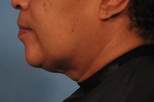 Renuvion Lower Face and Neck Lift Before & After Case 265 before