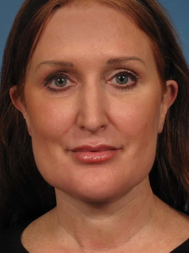 Renuvion Lower Face and Neck Lift Before & After Case 280 after