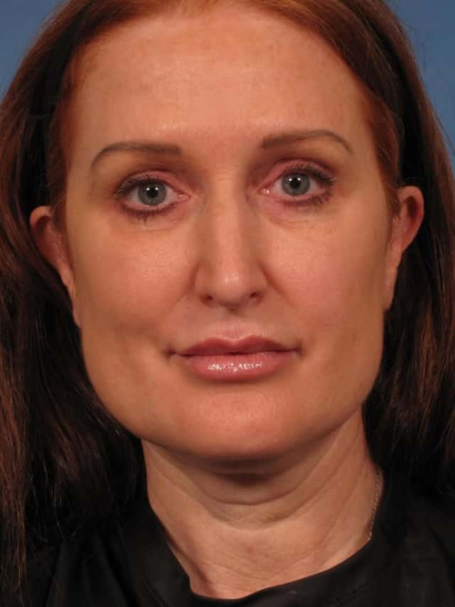 Renuvion Lower Face and Neck Lift Before & After Case 280 before