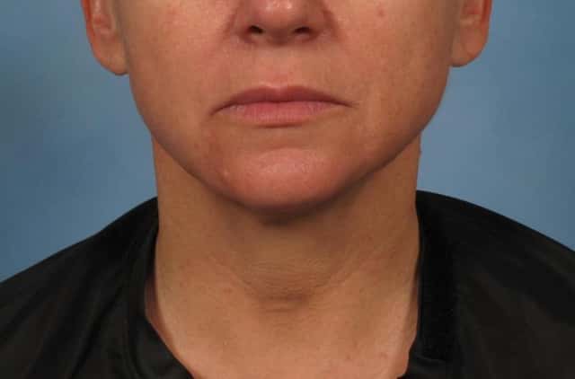 Renuvion Lower Face and Neck Lift Before & After Case 281 after