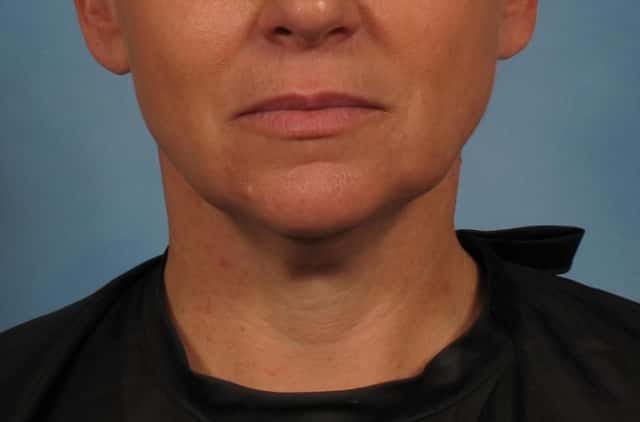 Renuvion Lower Face and Neck Lift Before & After Case 281 before
