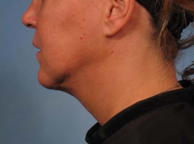 Renuvion Lower Face and Neck Lift Before & After Case 282 after