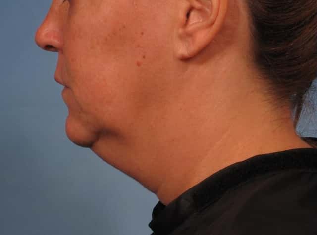 Renuvion Lower Face and Neck Lift Before & After Case 282 before