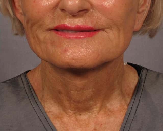 Renuvion Lower Face and Neck Lift Before & After Case 285 after