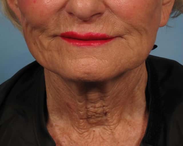 Renuvion Lower Face and Neck Lift Before & After Case 285 before