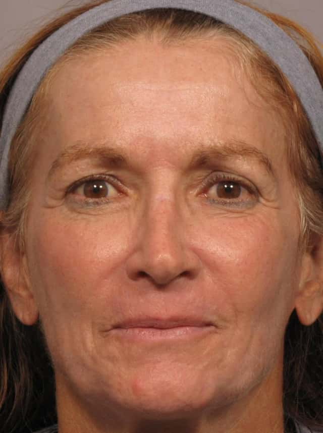Laser Resurfacing - Sciton Contour TRL Before & After Case 316 after