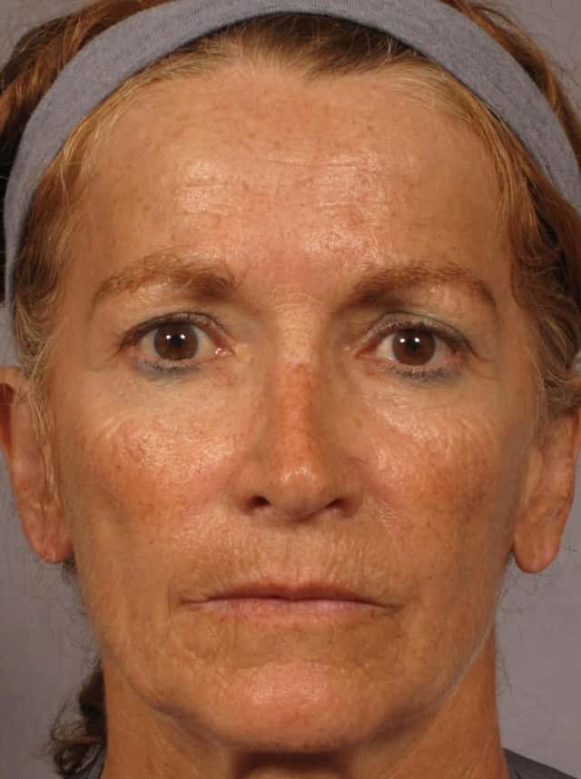 Laser Resurfacing - Sciton Contour TRL Before & After Case 316 before