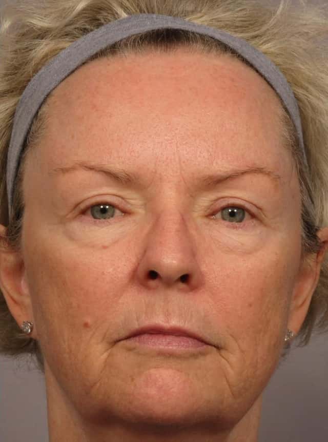 Laser Resurfacing - Sciton Contour TRL Before & After Case 317 after