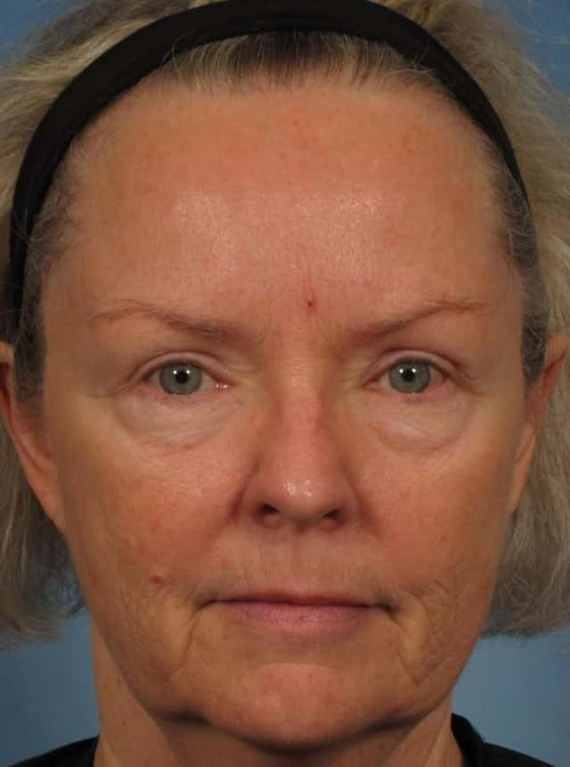 Laser Resurfacing - Sciton Contour TRL Before & After Case 317 before