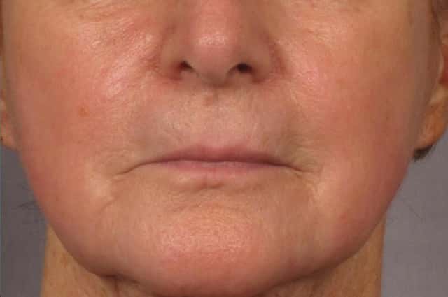 Laser Resurfacing - Sciton Contour TRL Before & After Case 318 after