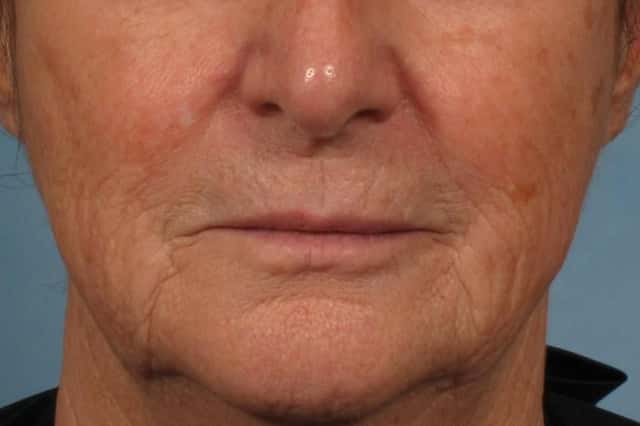 Laser Resurfacing - Sciton Contour TRL Before & After Case 318 before