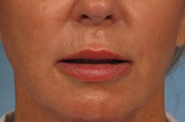Lip Augmentation Before & After Case 201 after