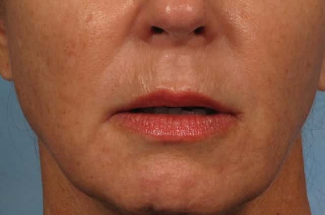 Lip Augmentation Before & After Case 201 before
