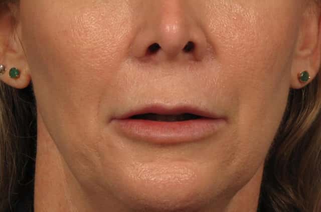Lip Augmentation Before & After Case 242 after