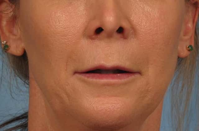 Lip Augmentation Before & After Case 242 before