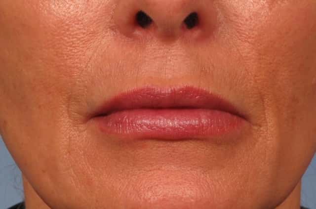 Lip Augmentation Before & After Case 243 after