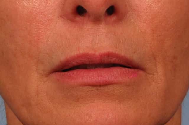 Lip Augmentation Before & After Case 243 before