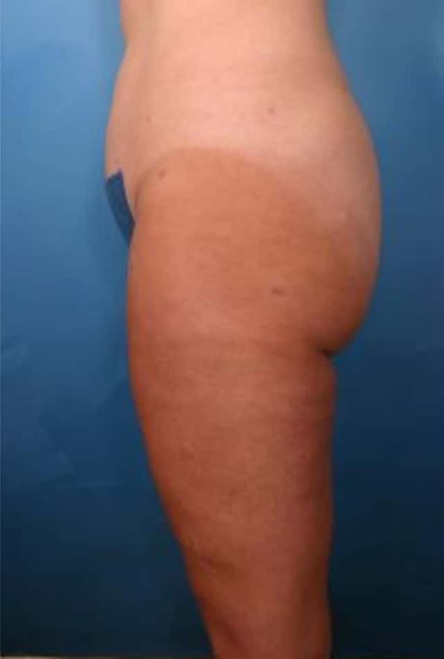 Liposuction Before & After Case 11 after