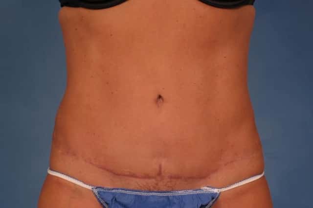 Liposuction Before & After Case 235 after