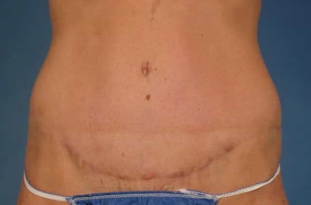 Liposuction Before & After Case 236 after