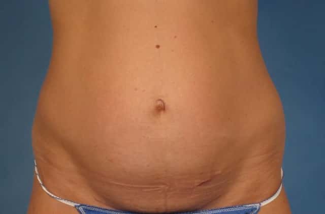 Liposuction Before & After Case 236 before