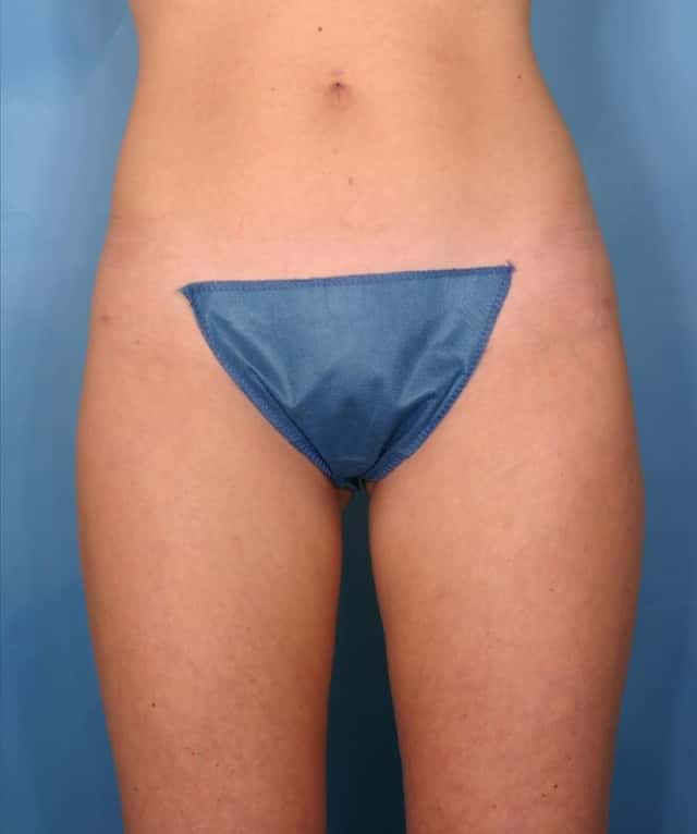 Liposuction Before & After Case 25 after