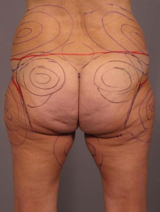 Liposuction Before & After Case 292 after