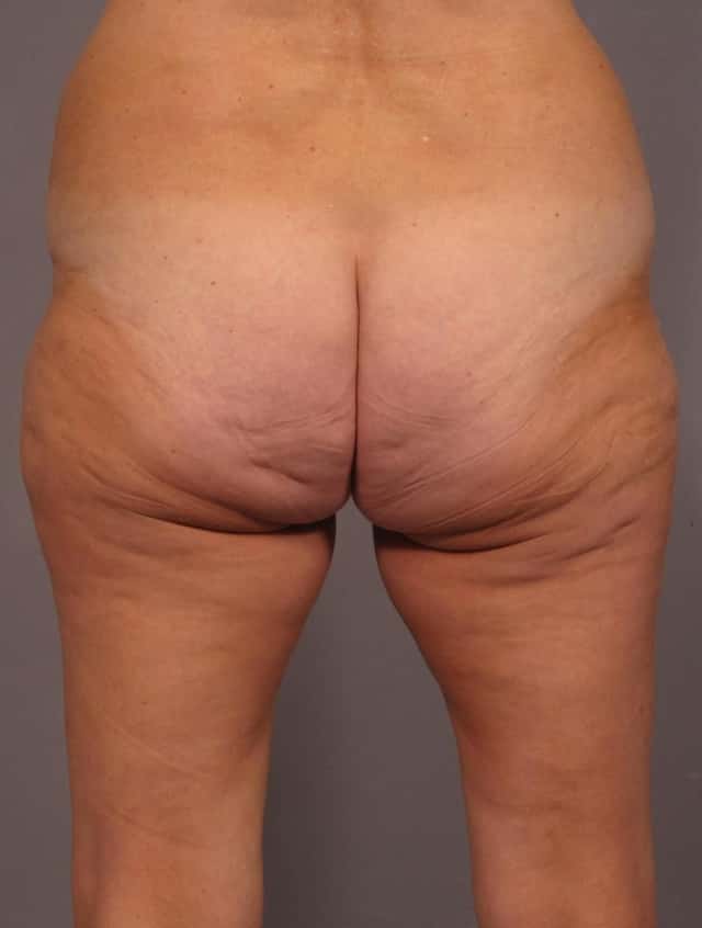 Liposuction Before & After Case 292 before