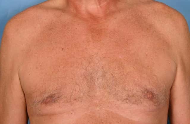 Liposuction Before & After Case 30 after