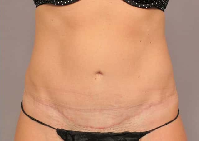 Liposuction Before & After Case 305 after