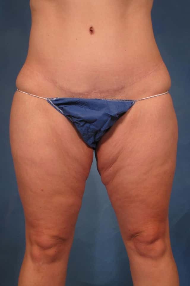 Liposuction of Thighs/Hips Before and 1 Year After, Front View