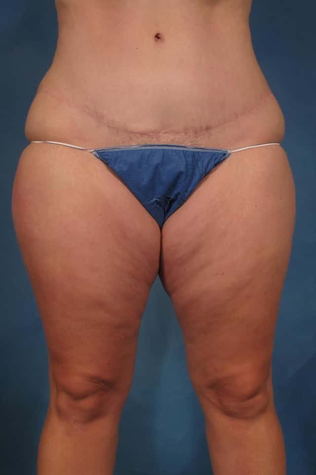 Liposuction of Thighs/Hips Before and 1 Year After, Front View