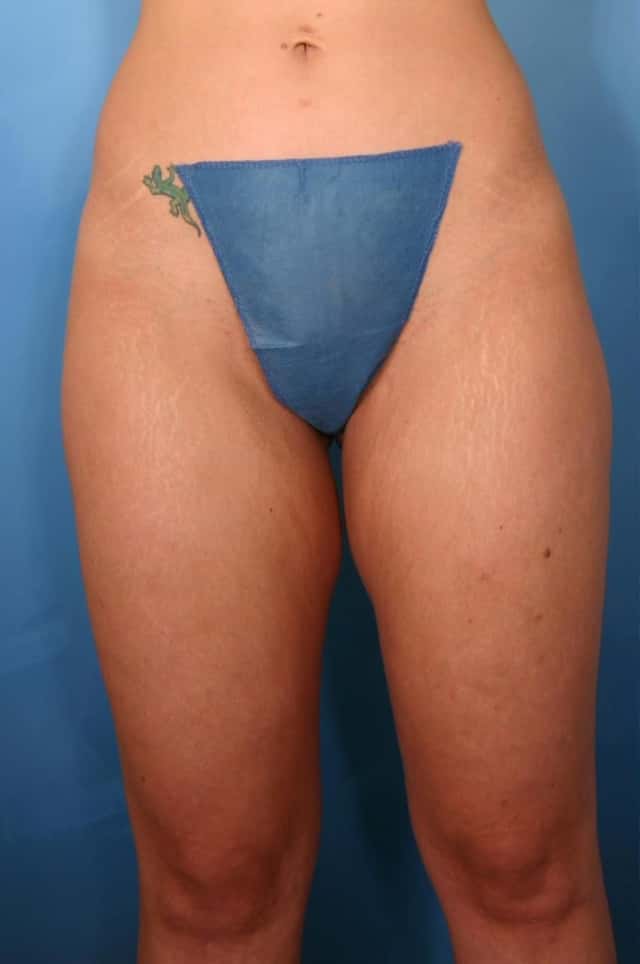 Liposuction Before & After Case 42 before