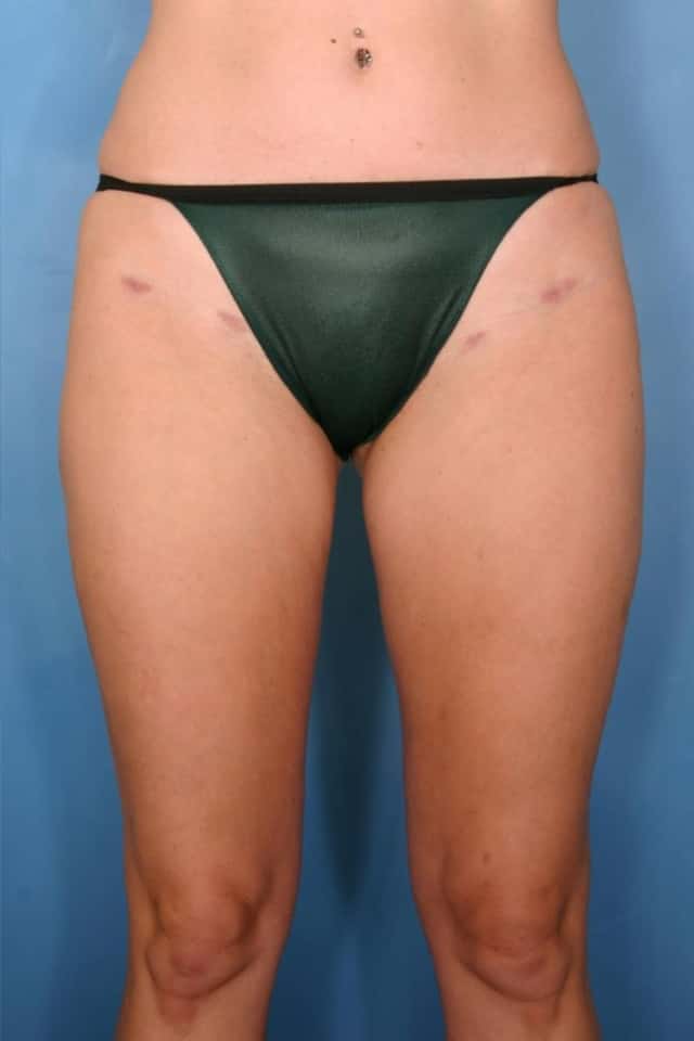 Liposuction Before & After Case 82 after