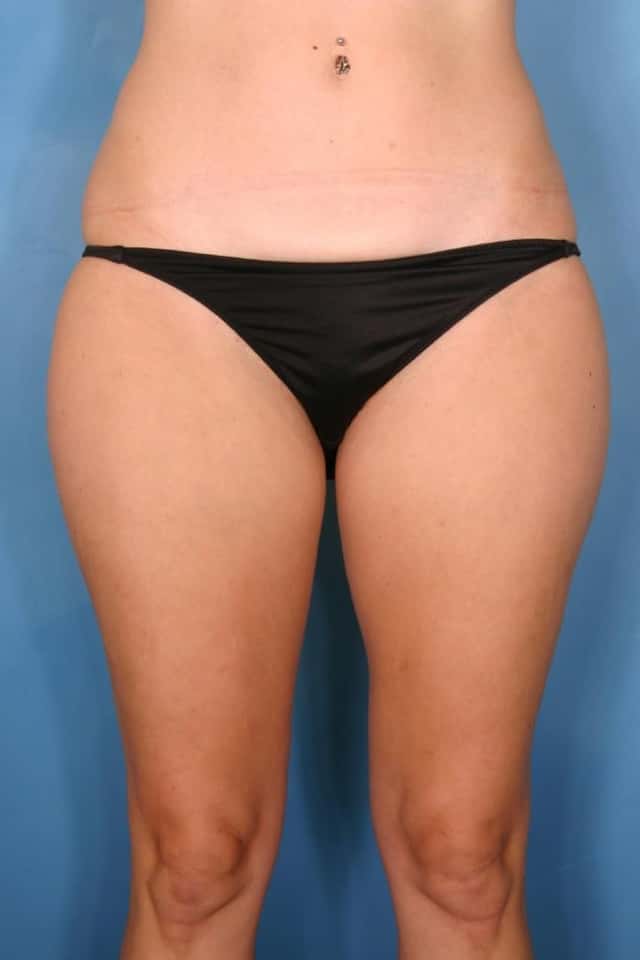 Liposuction Before & After Case 82 before