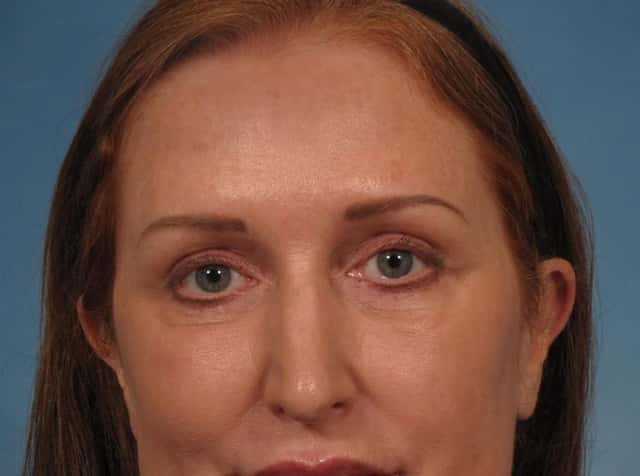 Madonna Lift Before & After Case 283 after
